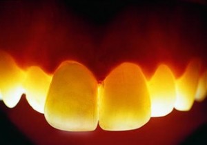 Циркониевые коронки для зубов: фото, отзывы
