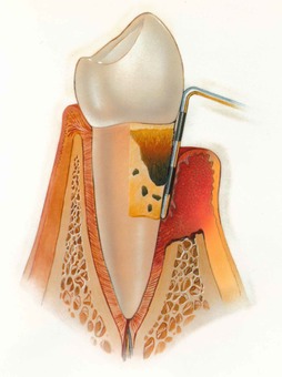Болит зуб при надавливании: почему и что делать