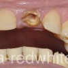 Имплантация переднего зуба фото до и после