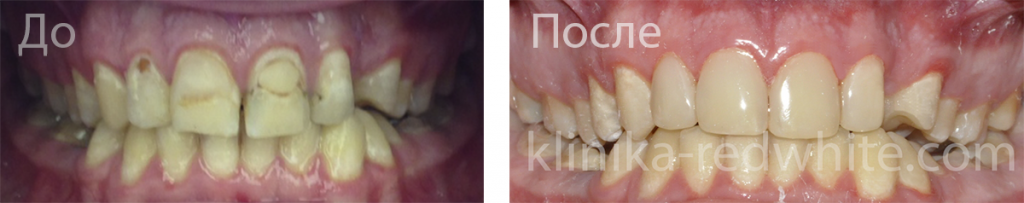 Фото до и после художественной реставрации зубов