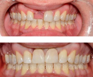 фото одноэтапной моментальной имплантации в твери, где установить импланты зубов в твери