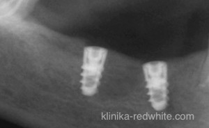 фото импланта зуба